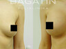 Breast augmentation 24
