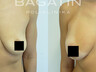 Breast augmentation 4