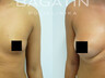 Breast augmentation 6