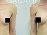 Breast augmentation 7