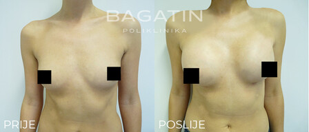Povecanje grudi