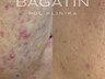 SkinPen 2