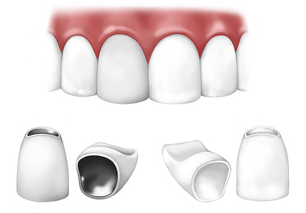 Zahnkronen und Zahnbrücken