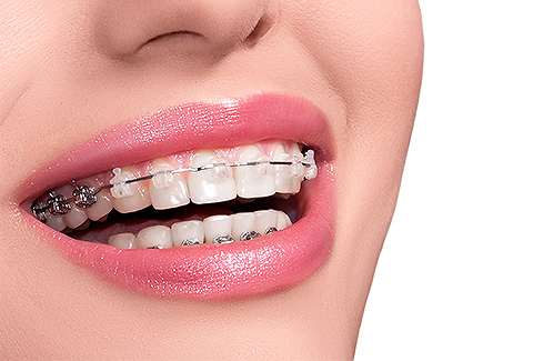 Orthodontics – the newest addition to our Dental center 