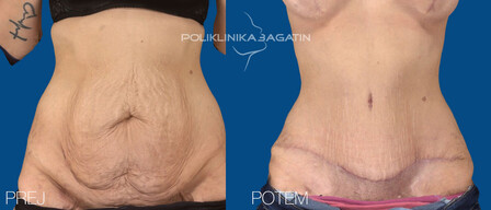 Abdominoplastika 1 SLO