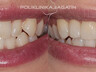 dental crowns 4
