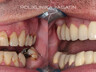 Dental crowns 6