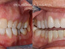 Dental crowns 7