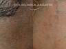 Lasersko odstranjevanje dlak 4 SLO