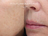 Lasersko uklanjanje hiperpigmentacije i ostalih kožnih promjena 1-ENG