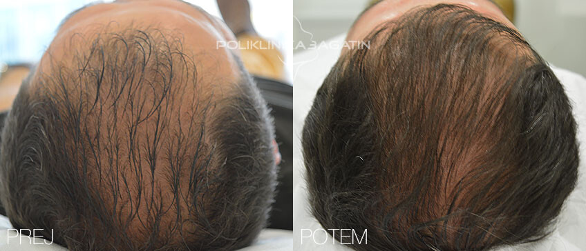 PRP terapija za redke lase 1 SLO