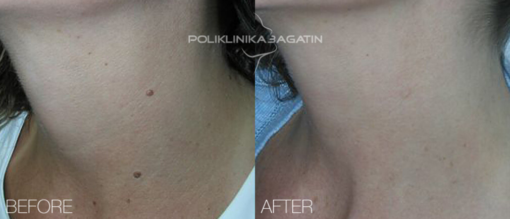 Radiofrequency Removal Of Moles And Other Changes