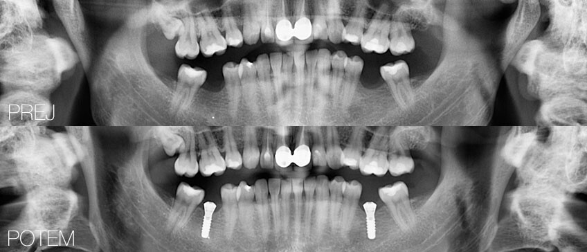 Zobni implantati 1 SLO