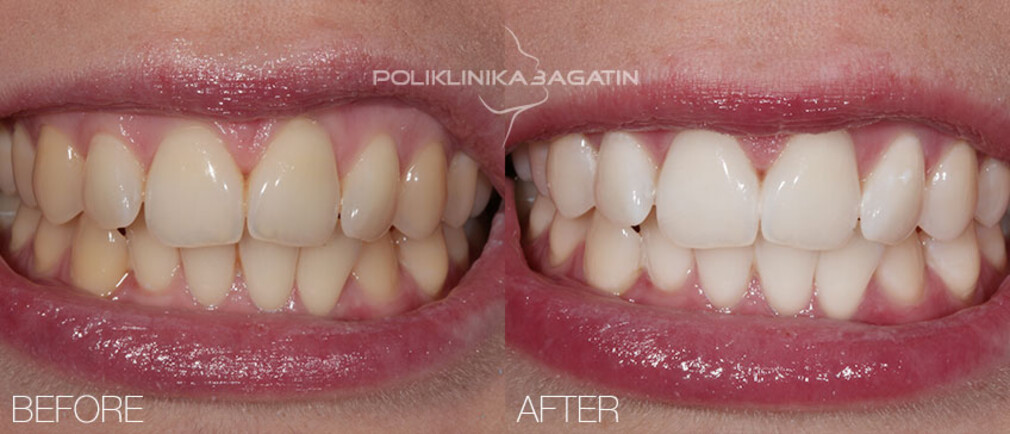 zoom-whitening-offer-smile-style-dental