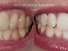 Zoom teeth whitening 2