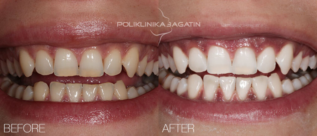 Teeth whitening 22304