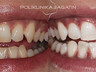 Zoom teeth whitening