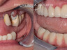 Zobni implantati slo 2