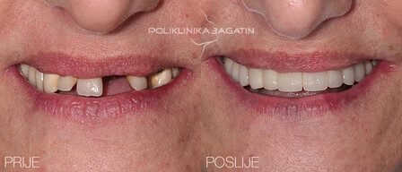 Zubni implantati 1