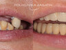 Zubni implantati 2