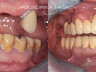 Zubni implantati 4