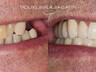 Zubni implantati 5