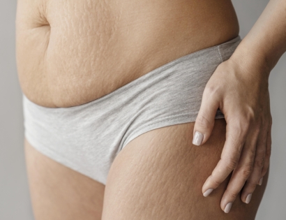 strije na bedrima i po trbuhu